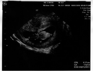 Ultrasound 11wks 1 day Oct01 2010